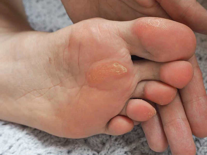 Calluses & Corns - Valley Foot & Ankle Specialty Providers
