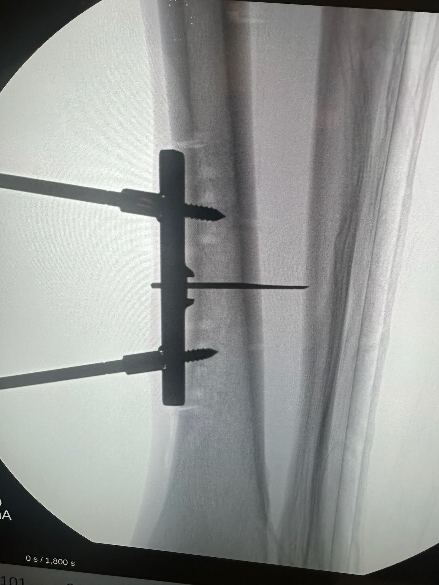 First Case with TrueLok 3